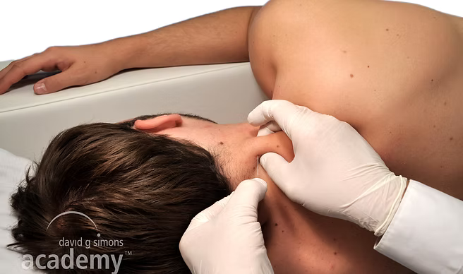 Dry needling du quadrant supérieur réalisé en kinésithérapie, formation Kpten