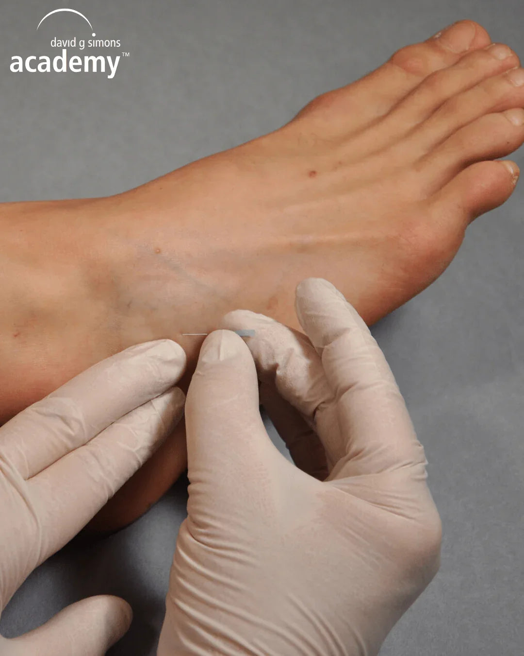 Dry needling au pied, kinésithérapie avancée, formation Kpten