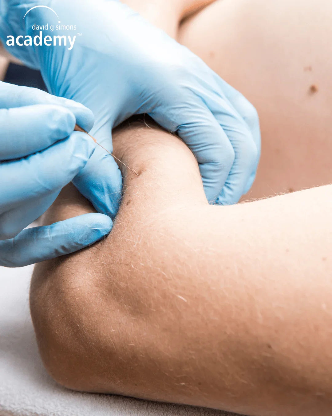 Séance de dry needling sur le bras en formation kinésithérapie Kpten Formation