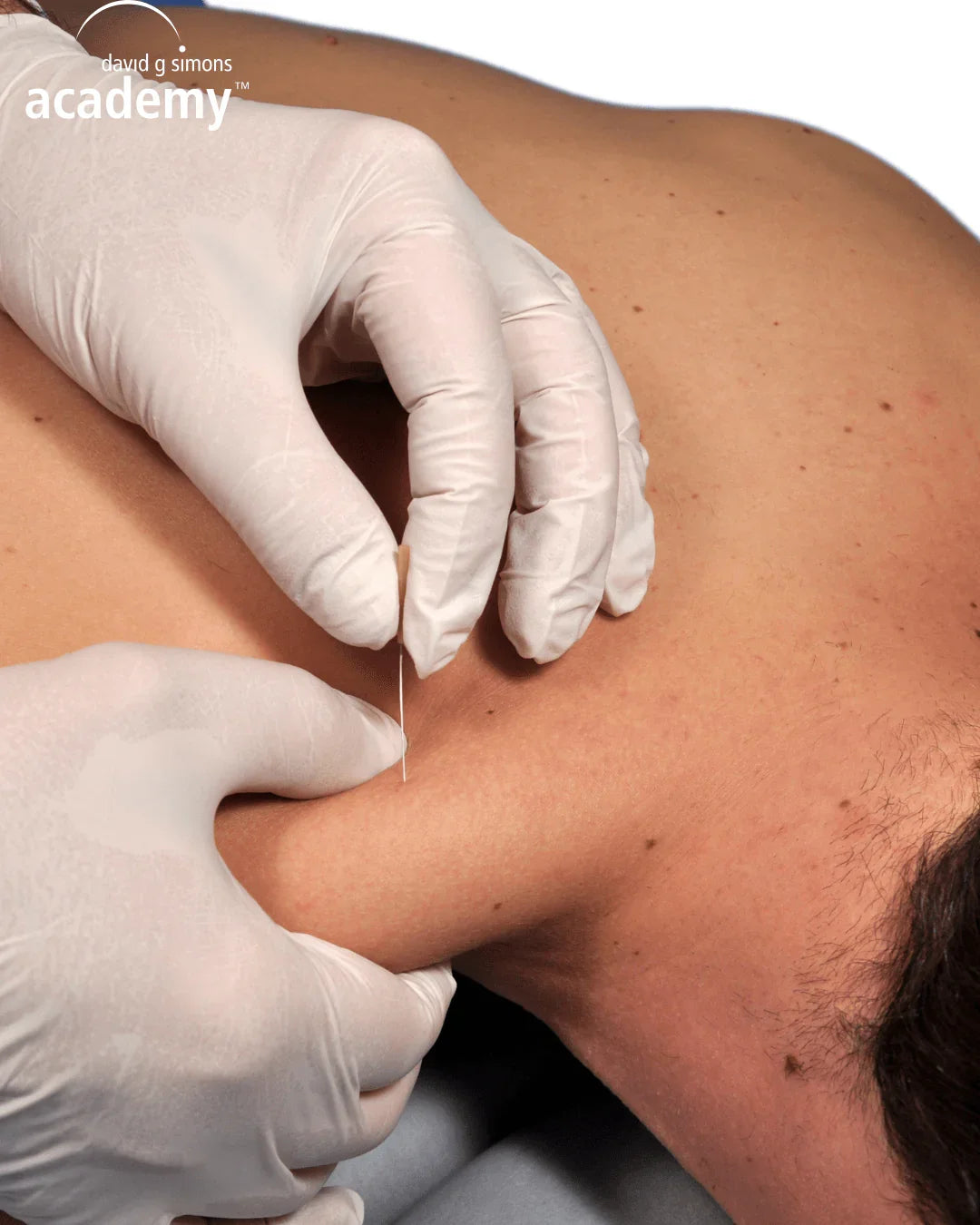 Dry needling sur épaule par un kinésithérapeute avec gants, formation Kpten
