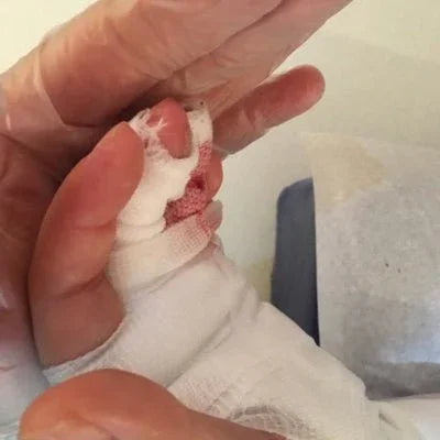 Rééducation main traumatisée avec bandage, soins des lésions tendineuses, kinésithérapie