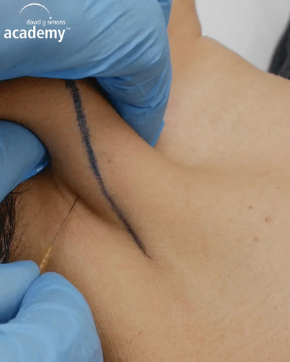 Dry needling sur point trigger du cou, démonstration en formation kinésithérapie Kpten.