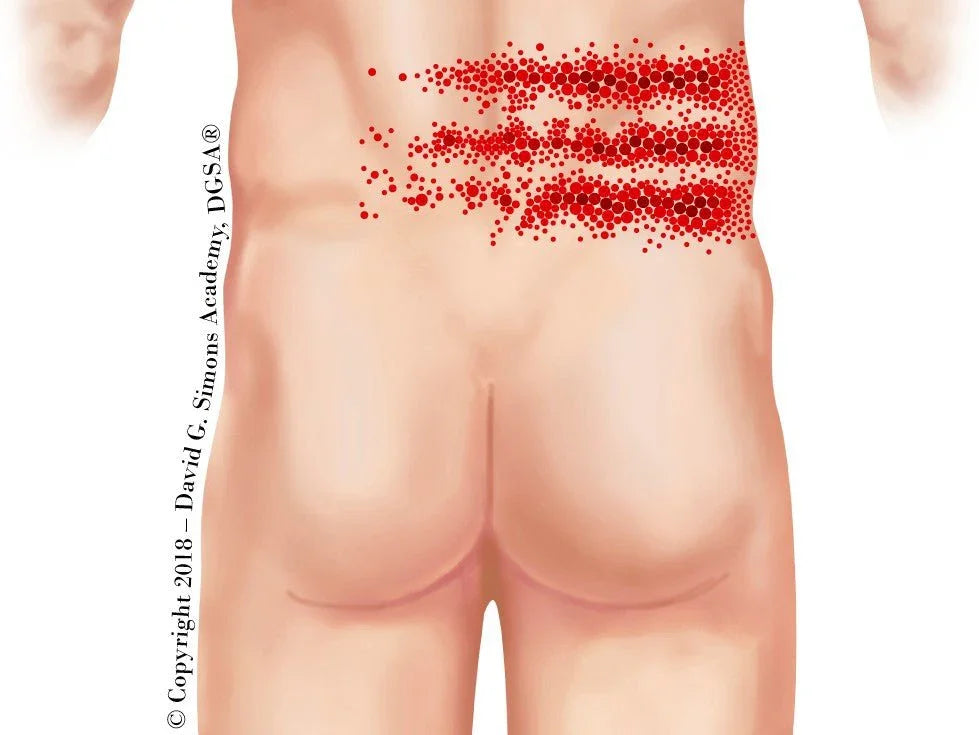 Illustration du dos humain montrant les points trigger en rouge pour la thérapie manuelle et dry needling.