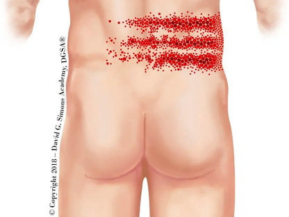 Illustration du dos humain montrant les points trigger en rouge pour la thérapie manuelle et dry needling.
